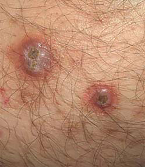Definition of Syphilis | Chapter 12 | Midwifery For Diploma In Nursing