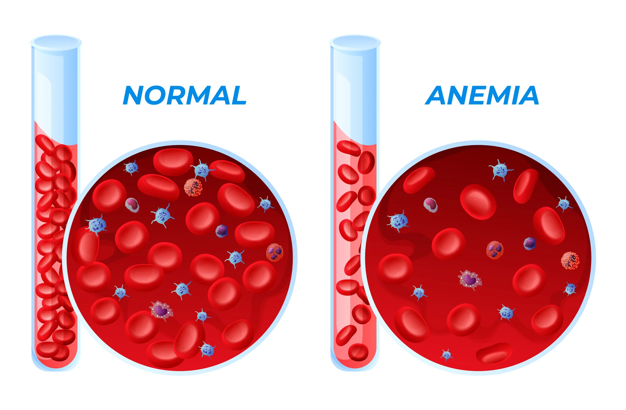 Anaemia with their causes | CHAPTER 5 | Anatomy and Physiology