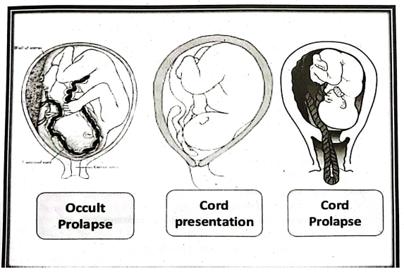 Cord Prolapse | Chapter 17 | Midwifery For Diploma In Nursing