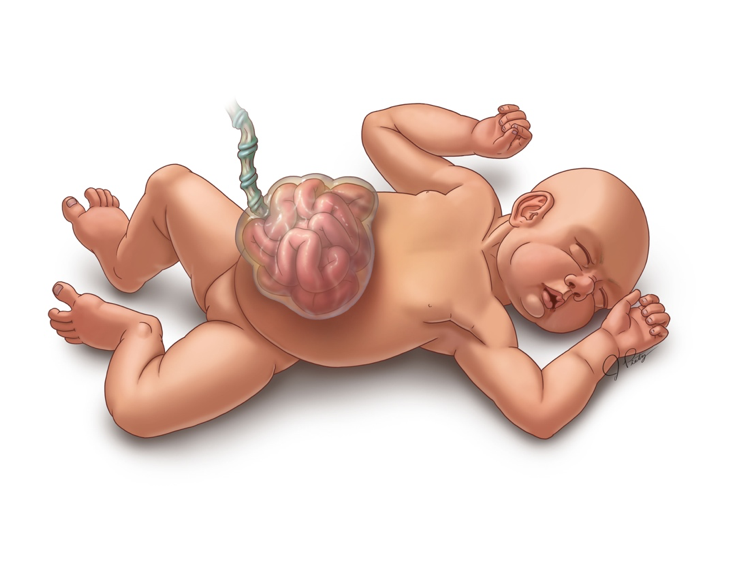 Classification of Omphalocele