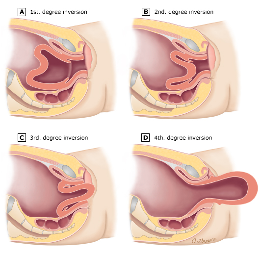 Uterine Inversion | Chapter 17 | Midwifery For Diploma In Nursing