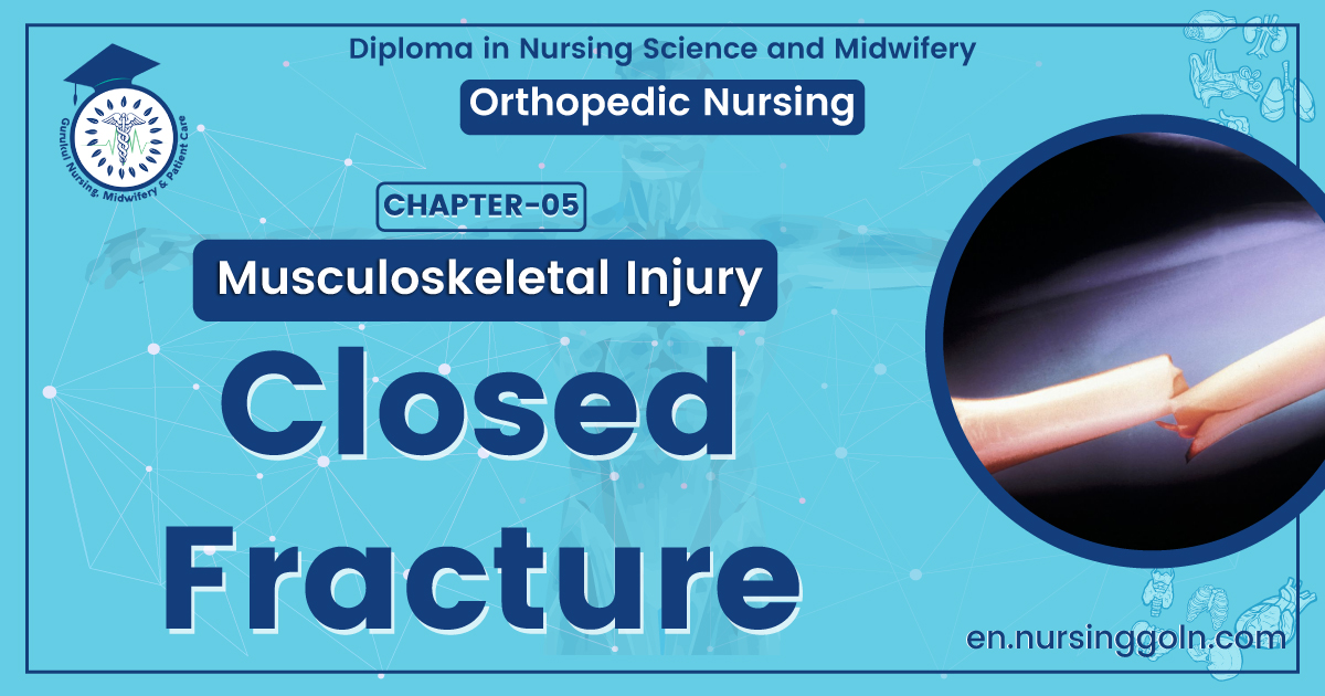 Closed Fracture | CHAPTER 5 | Orthopedic Nursing