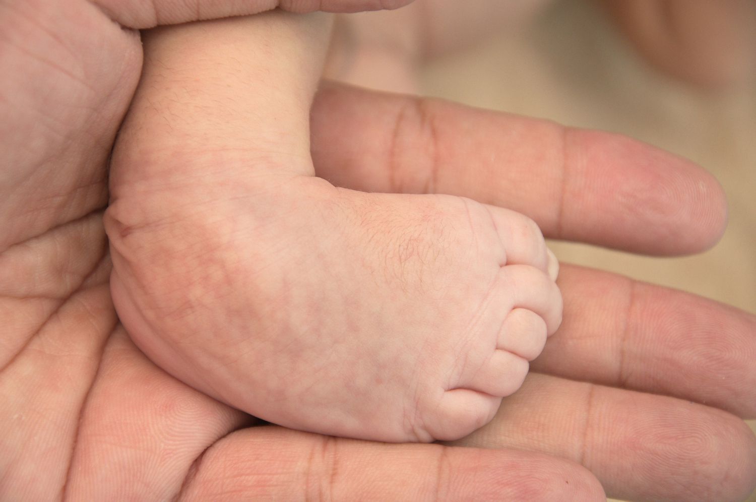 Concept About Club Foot | CHAPTER 20 | Orthopedic Nursing
