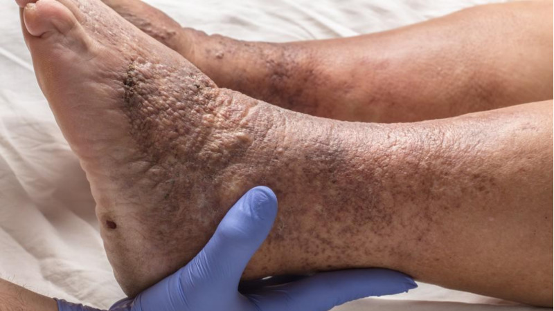 Deep Vein Thrombosis | CHAPTER 22 | Orthopedic Nursing