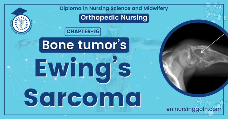 Ewing’s sarcoma
