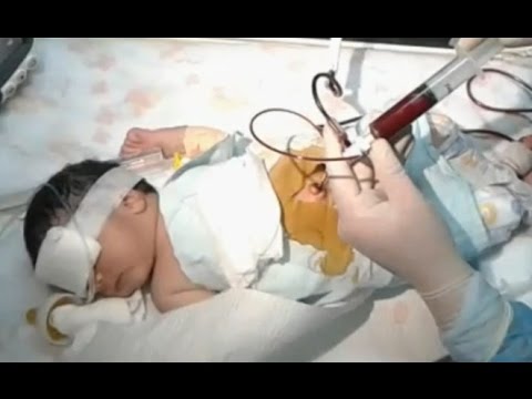 Exchange transfusion | CHAPTER 18 | Pediatric Nursing