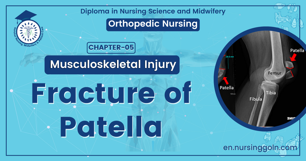Fracture of Patella | CHAPTER 5 | Orthopedic Nursing