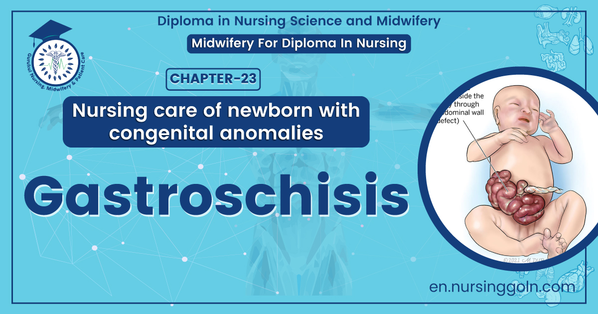 Gastroschisis