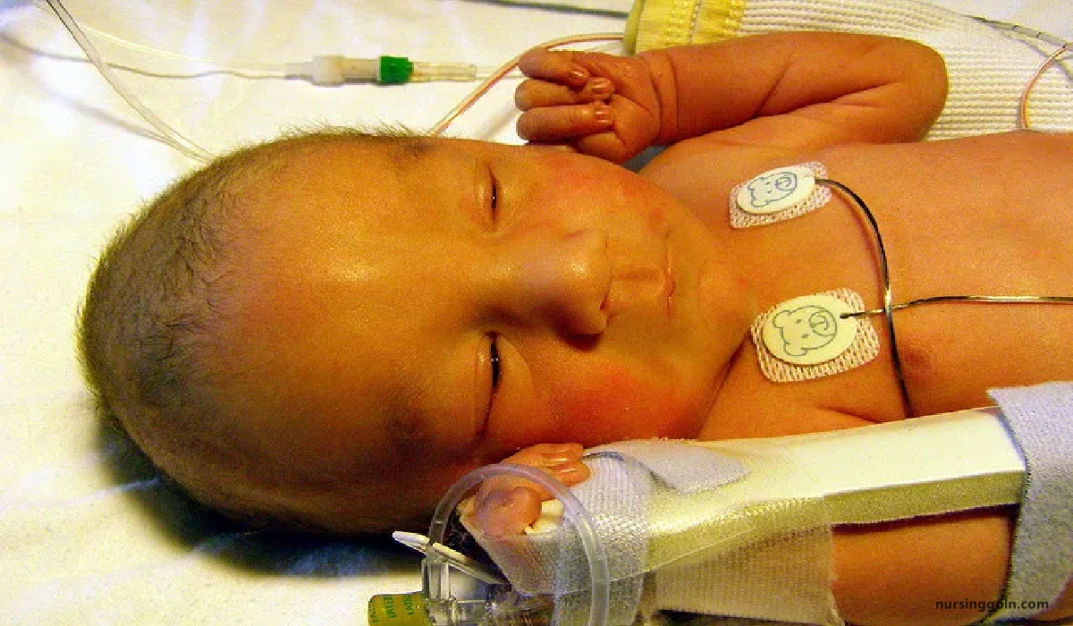 Physiological jaundice | CHAPTER 18 | Pediatric Nursing