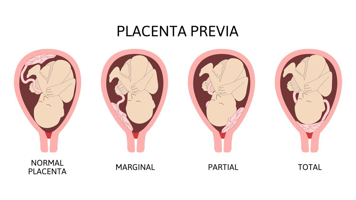 Concept about Placenta praevia