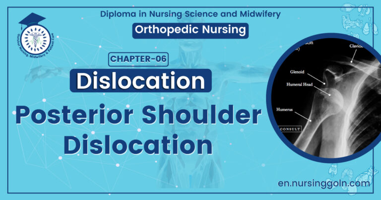 Posterior shoulder dislocation | CHAPTER 6 | Orthopedic Nursing