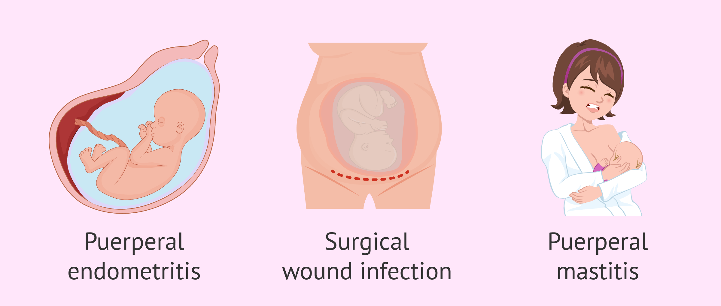 Postpartum Infection