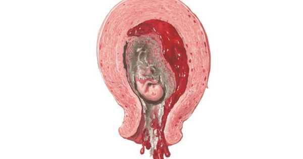 Septic abortion