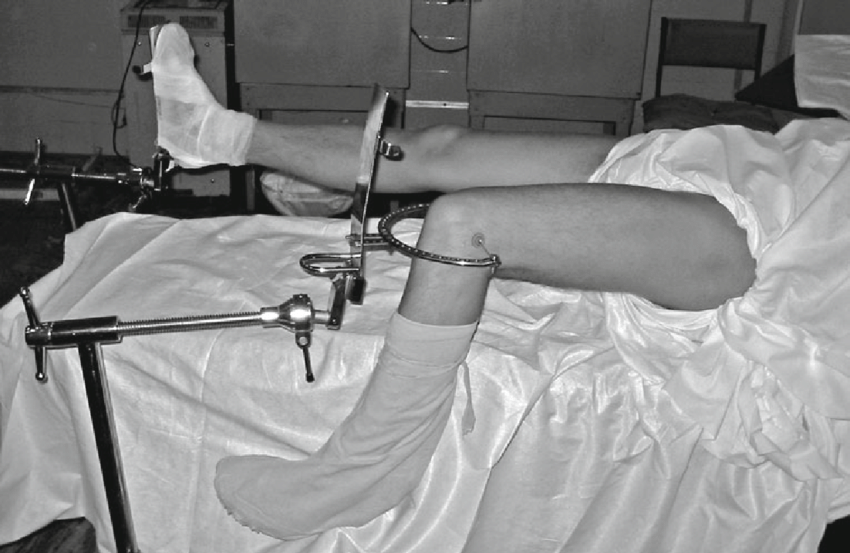 Skeletal Traction | CHAPTER 21 | Orthopedic Nursing
