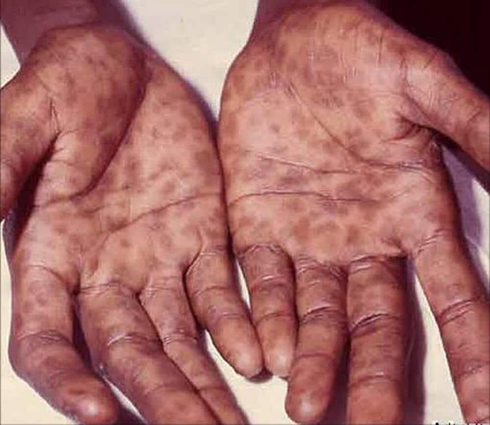 Definition of Syphilis | Chapter 12 | Midwifery For Diploma In Nursing