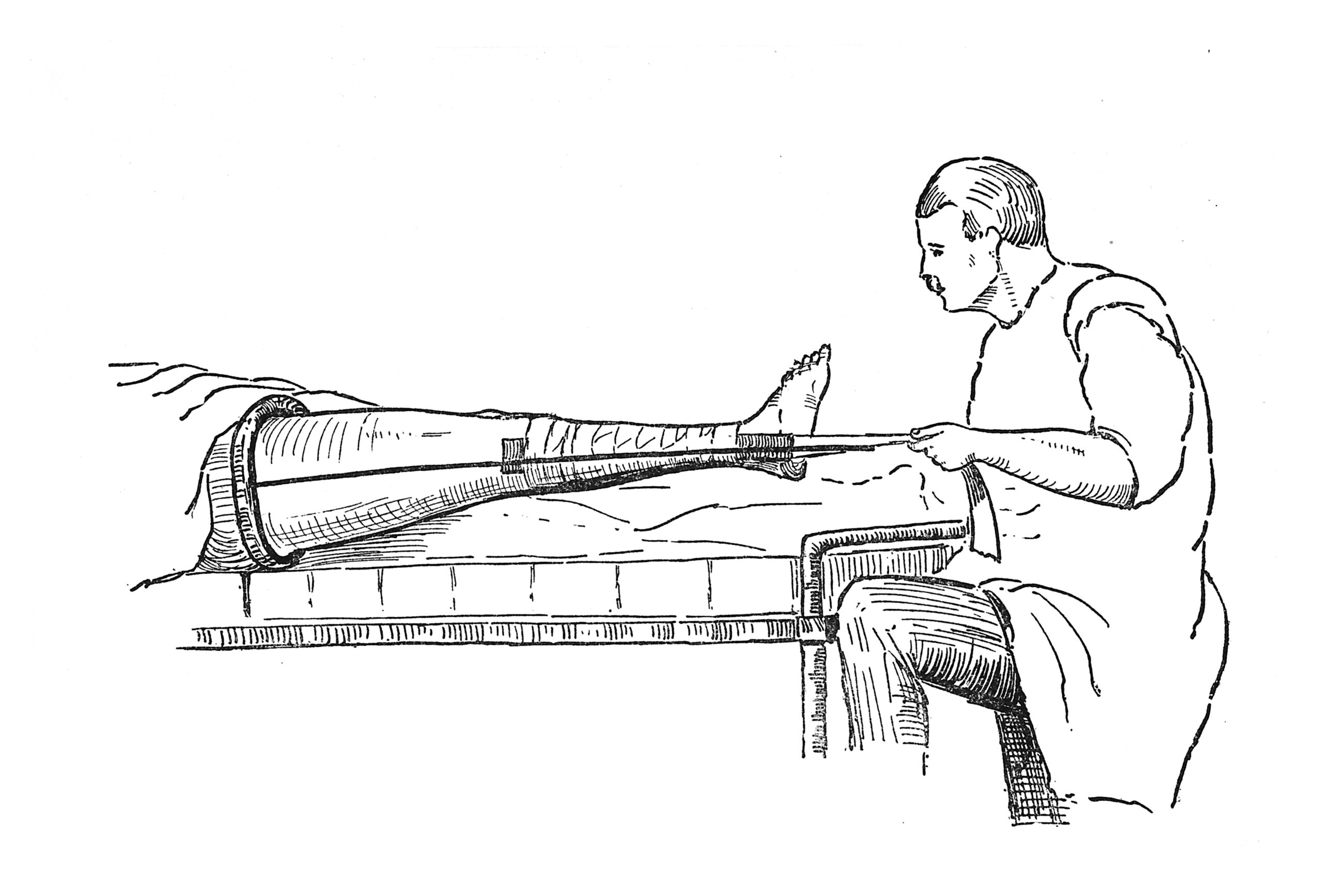 Thomas Splints | CHAPTER 21 | Orthopedic Nursing
