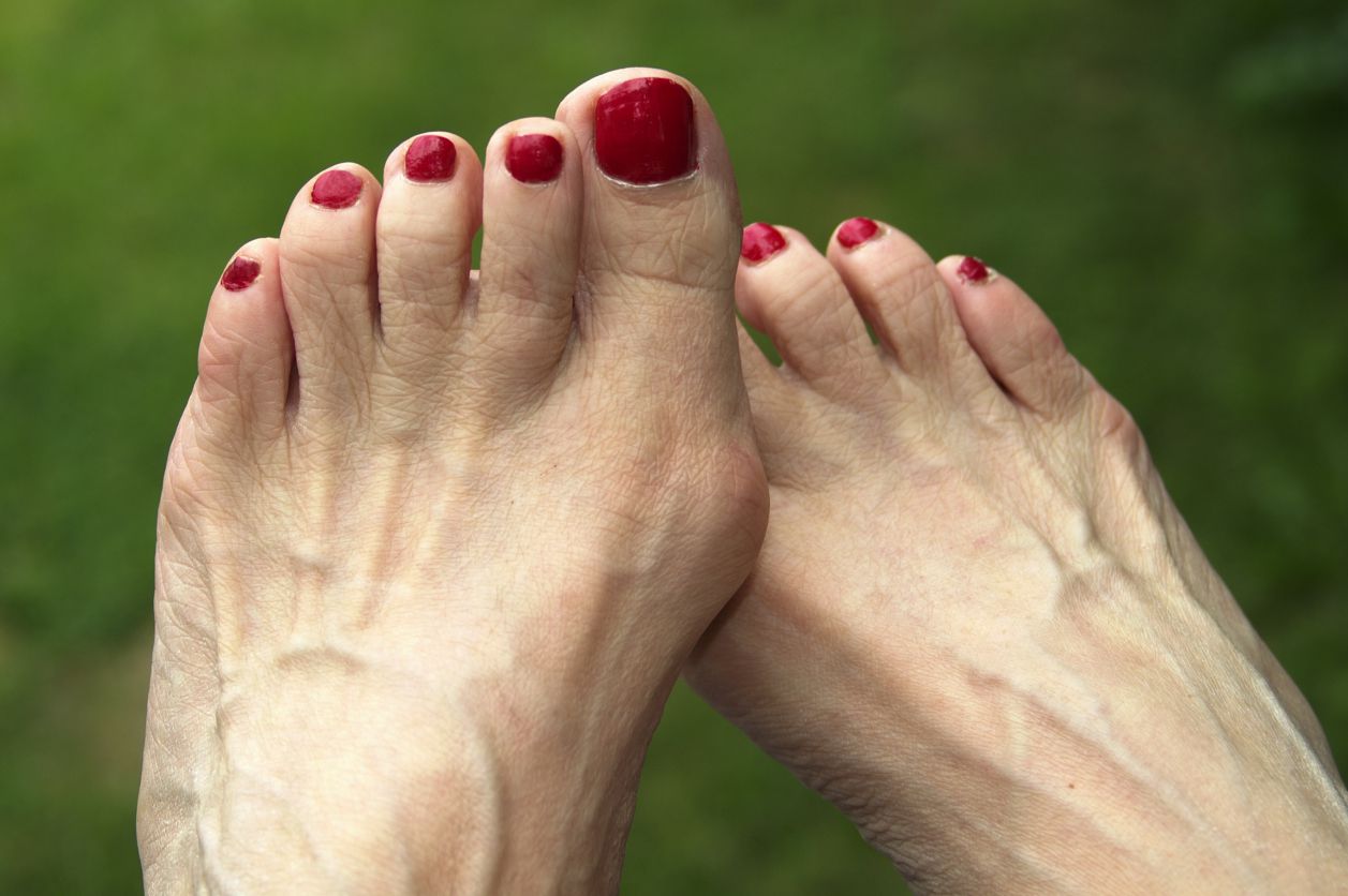 Concept About Club Foot | CHAPTER 20 | Orthopedic Nursing