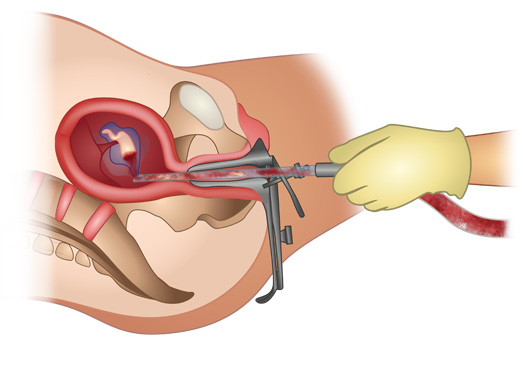 Definition of Abortion | Chapter 11 | Midwifery For Diploma In Nursing