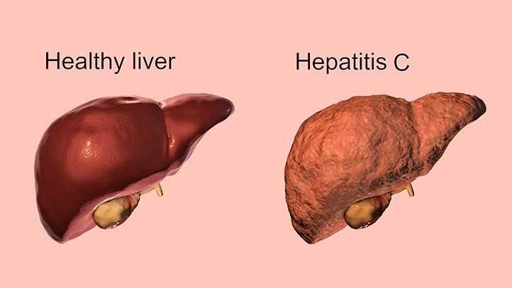 Definition of Hepatitis | Chapter 12 | Midwifery For Diploma In Nursing