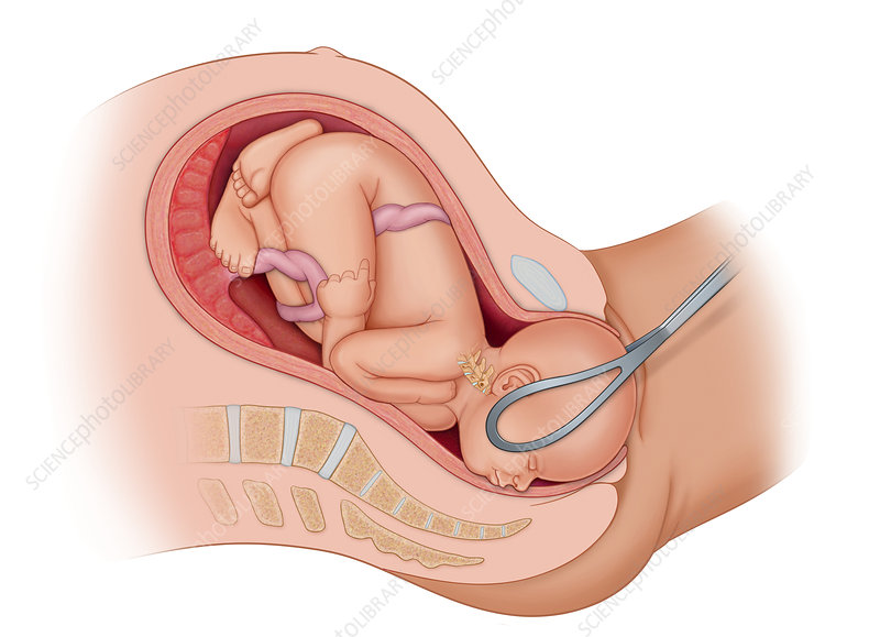 Instrumental deliveries | Chapter 16 | Midwifery For Diploma In Nursing