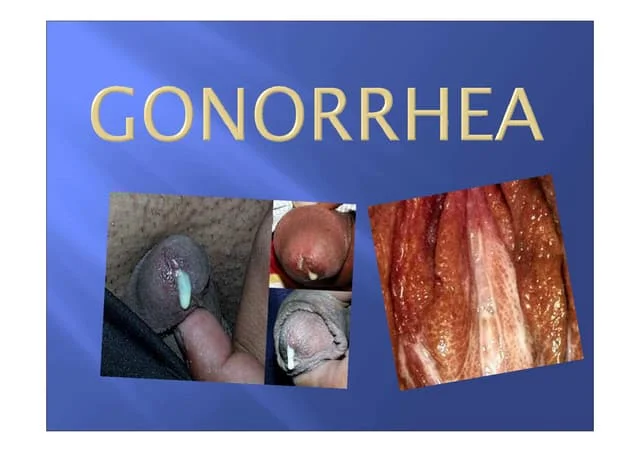 Definition of Gonorrhea | Chapter 12 | Midwifery For Diploma In Nursing