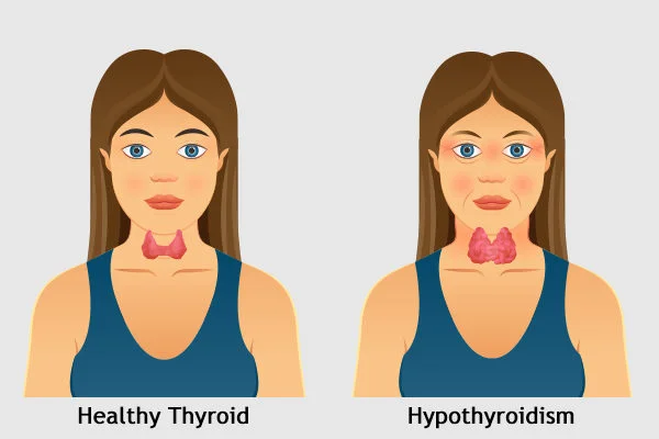 Definition of Hypothyroidism | Chapter 12 | Midwifery For Diploma In Nursing