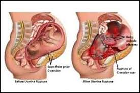 Rupture Uterus | Chapter 17 | Midwifery For Diploma In Nursing