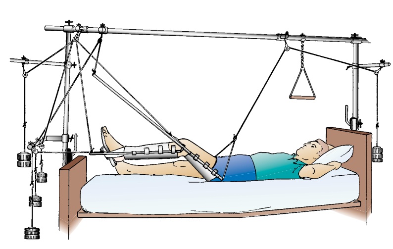 Skeletal Traction | CHAPTER 21 | Orthopedic Nursing