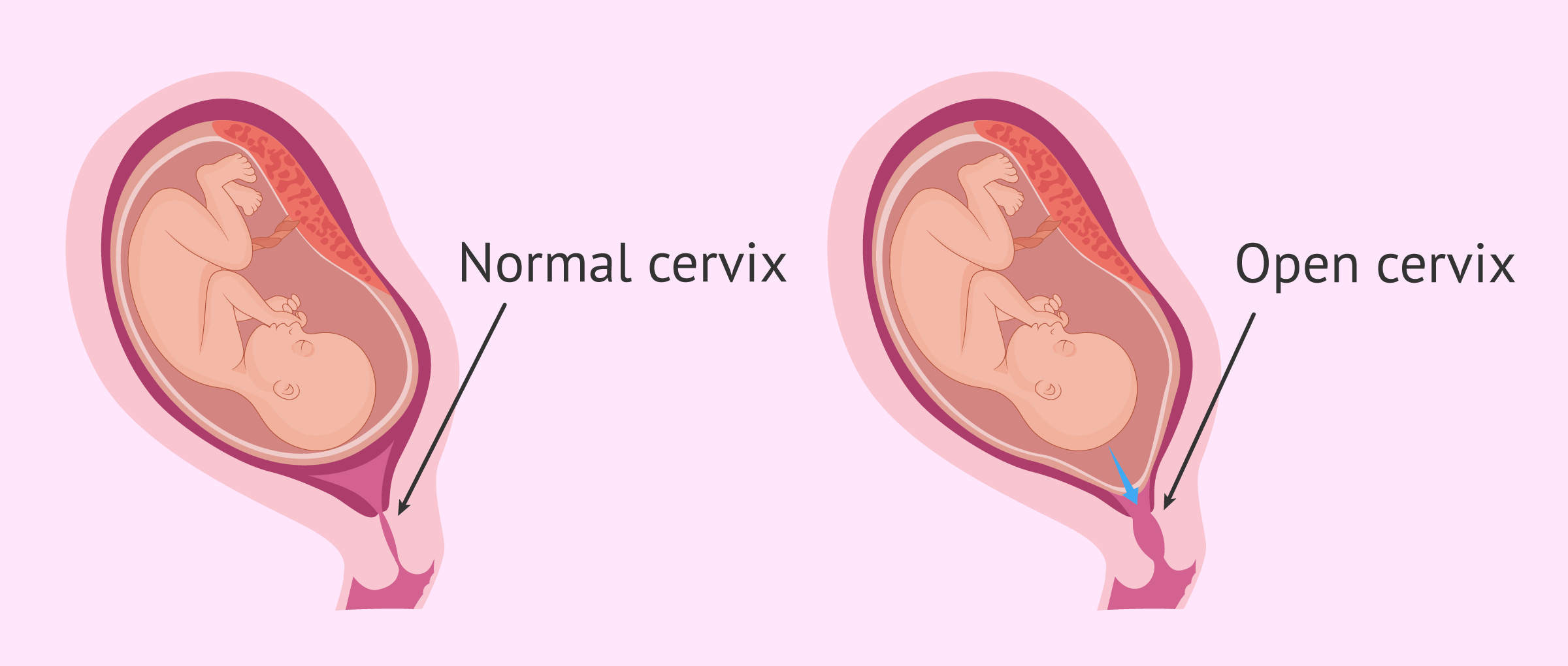 Cervical Incompetence | Chapter 17 | Midwifery For Diploma In Nursing